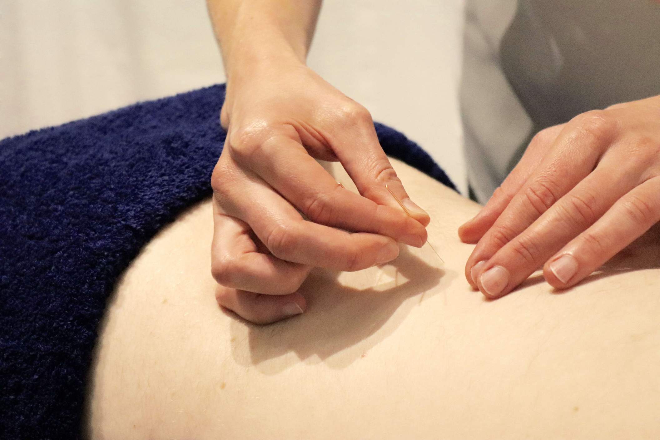 Acupuncture in St Margarets | Acupuncture Twickenham | Flawless Physio