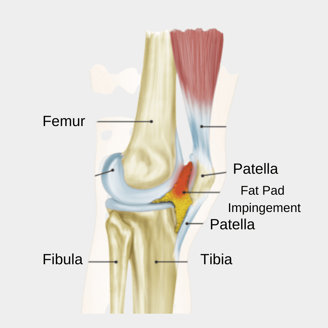 Fat Pad Knee Fat Pad: Anterior Knee Pain Impingement | Hoffa's Fat Pad
