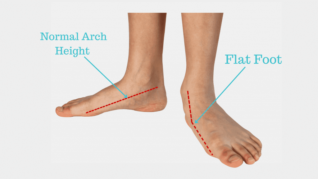 Inserts for store flat feet