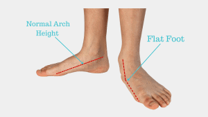Flat Feet 