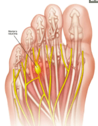 Picture of Morton's neuroma