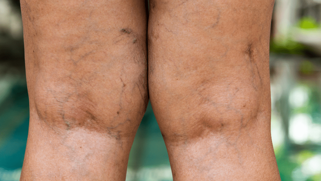 Bakers Cyst Bakers Cyst Symptoms Treatment And Exercises