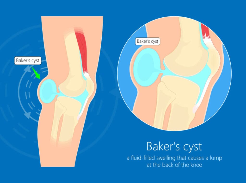 Baker's Cyst Diagram