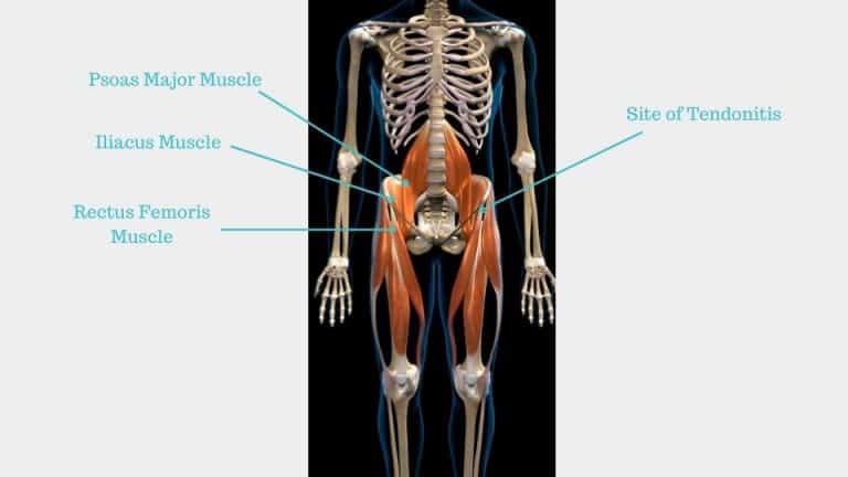 Hip Flexor Tendonitis Hip Flexor Tendinopathy Exercises