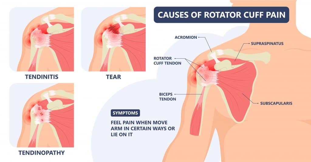 Picture of Rotator Cuff Pain