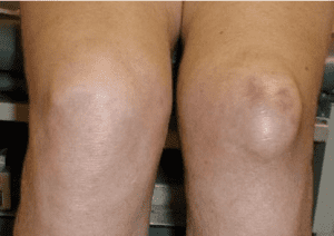 Housemaids Knee Photos