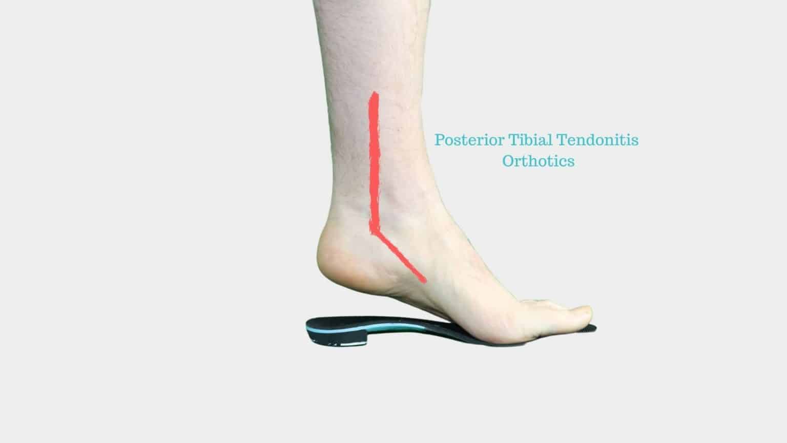 The Best Posterior Tibial Tendonitis Orthotics Custom Orthotics for PTTD