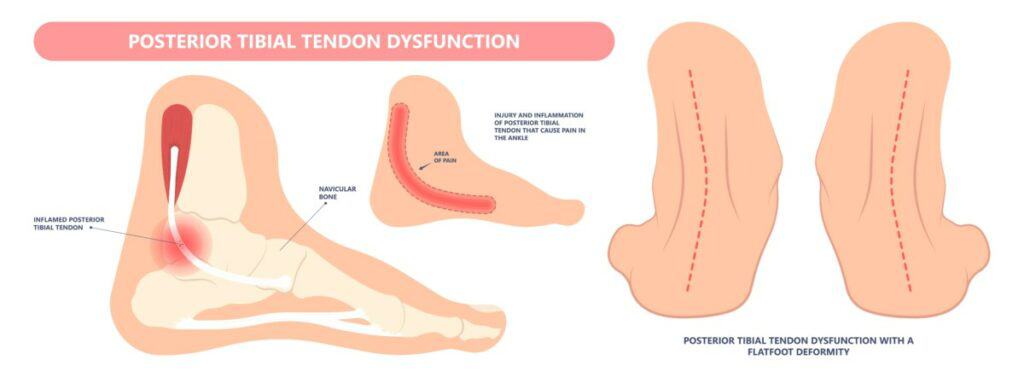 Diagram of (PTTD) Posterior Tibial Tendon Dysfunction results in the development of Adult Acquired flat foot