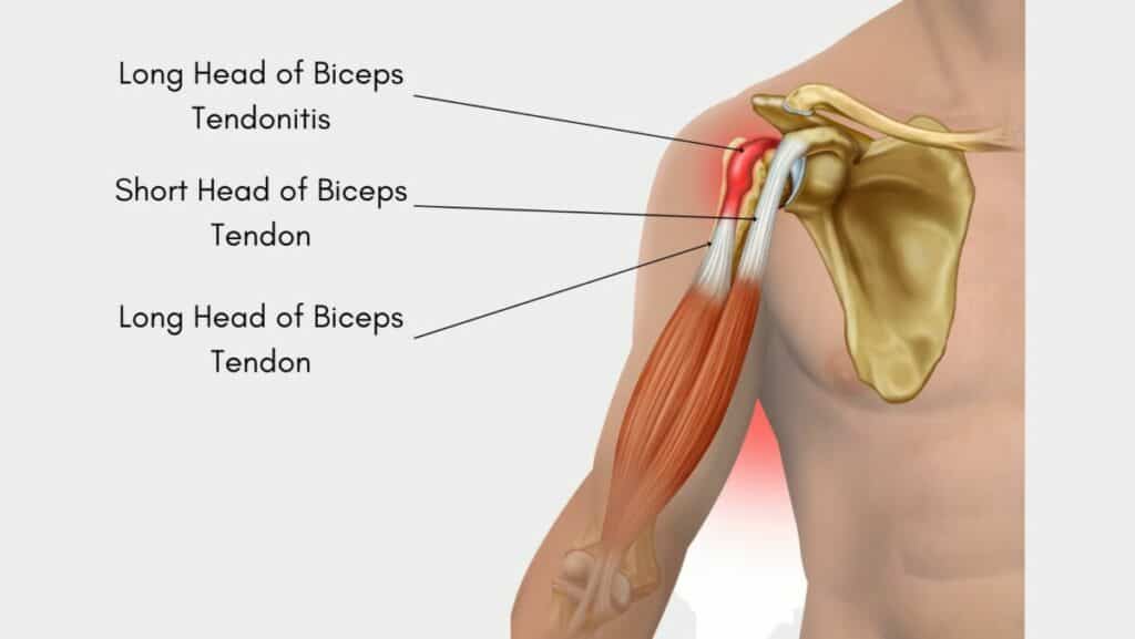 Long Head of Biceps Tendonitis Diagram