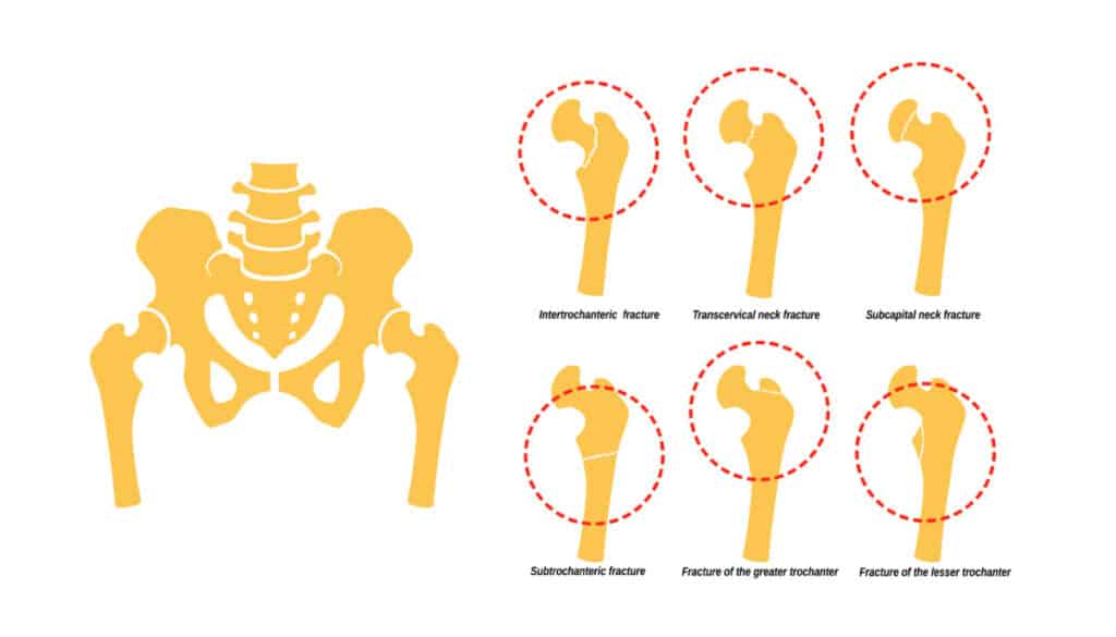 Diagram of Neck Of Femur Fracture types