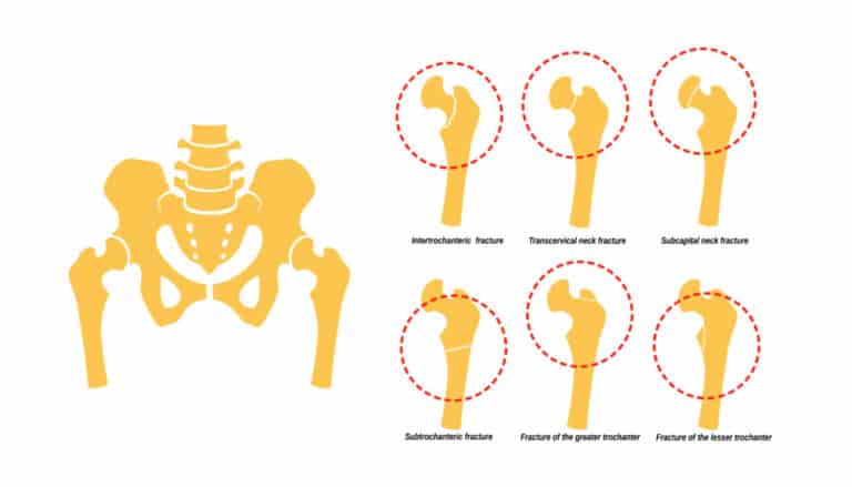 Neck of Femur Stress Fracture | Femur Stress Fracture Explained