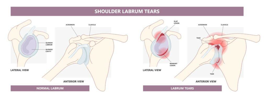Shoulder Labral Tear Diagram