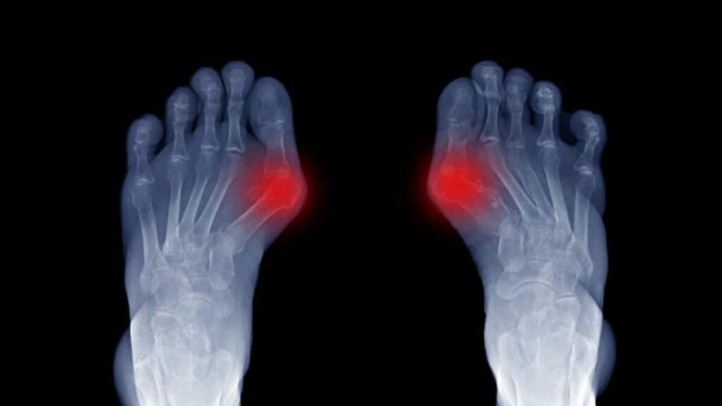 x-ray of big toe joint arthritis