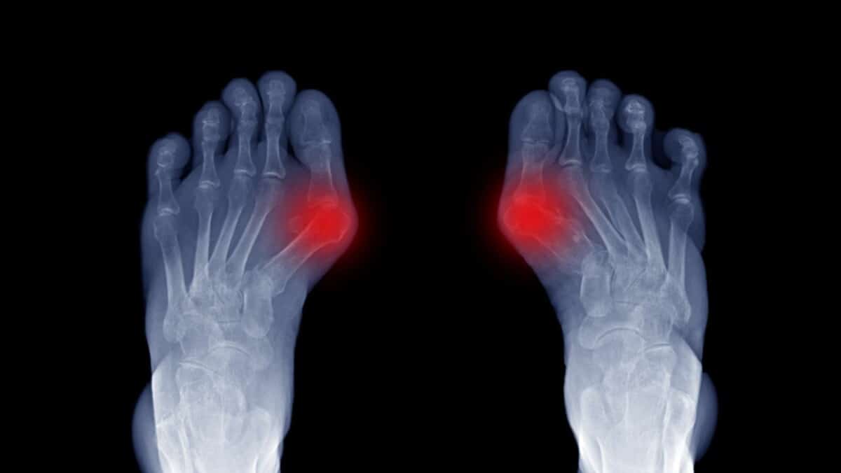 Arthritis in Big Toe Learn how to identify and treat Hallix Rigidus