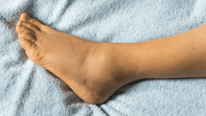 Photo of bruising and swelling of ankle sprain