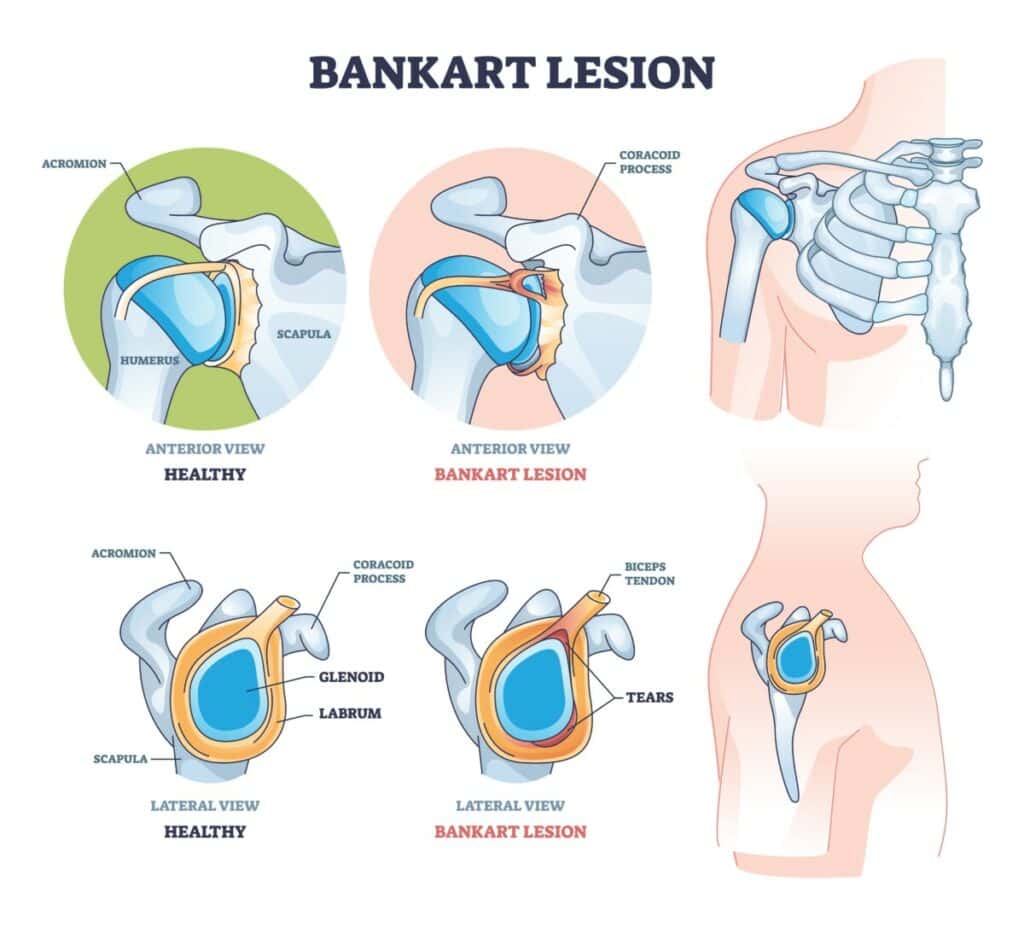 Bankart Lesion Diagram