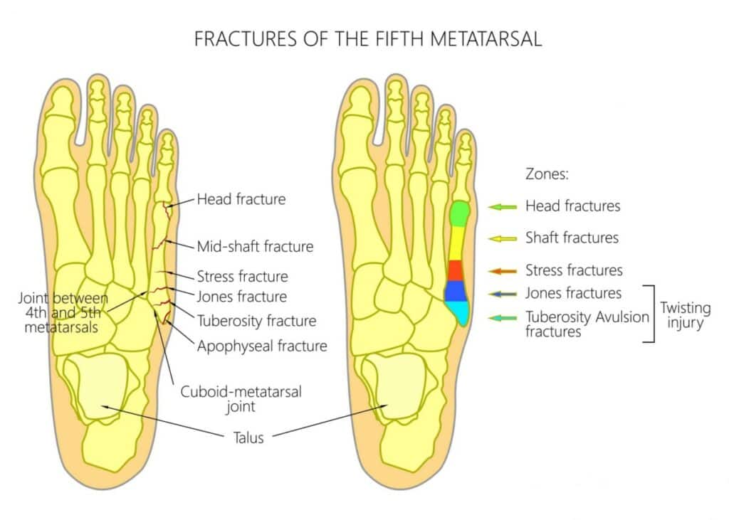 Diagram of 5th metatarsal Fracture