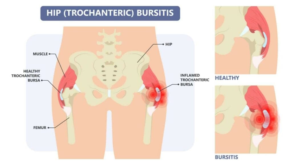 Hip Bursitis Diagram