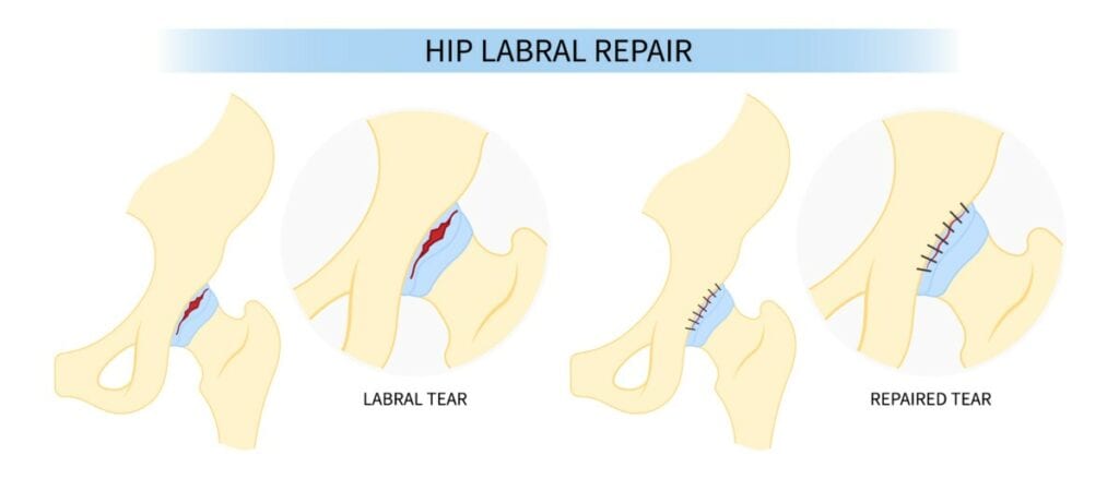 Hip Labral Repair Surgery Diagram