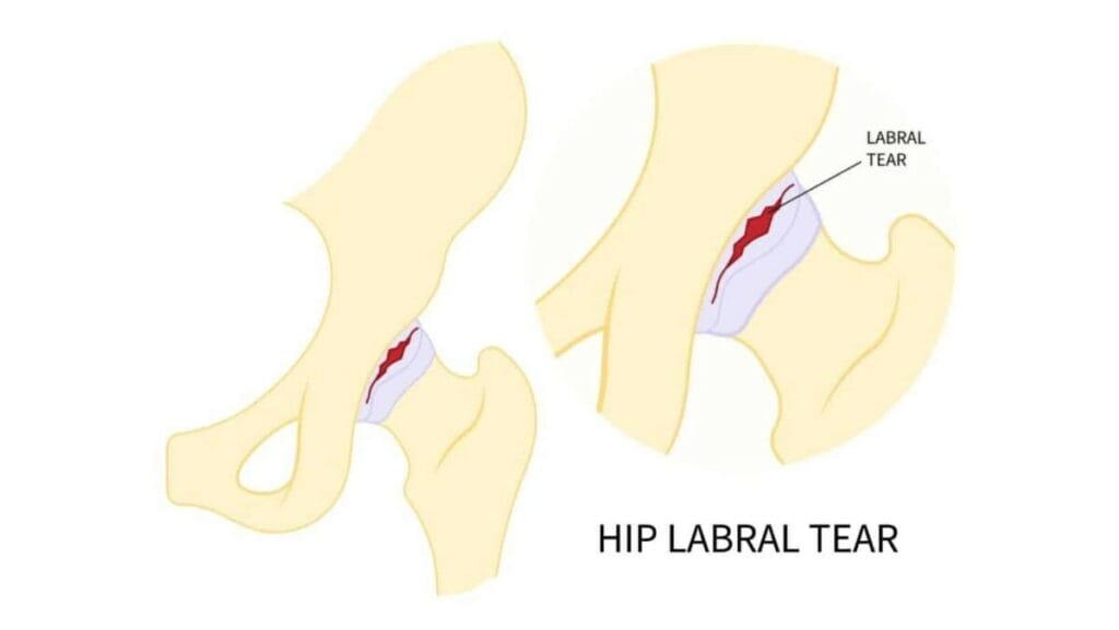 Picture of Hip Labral Tear Diagram