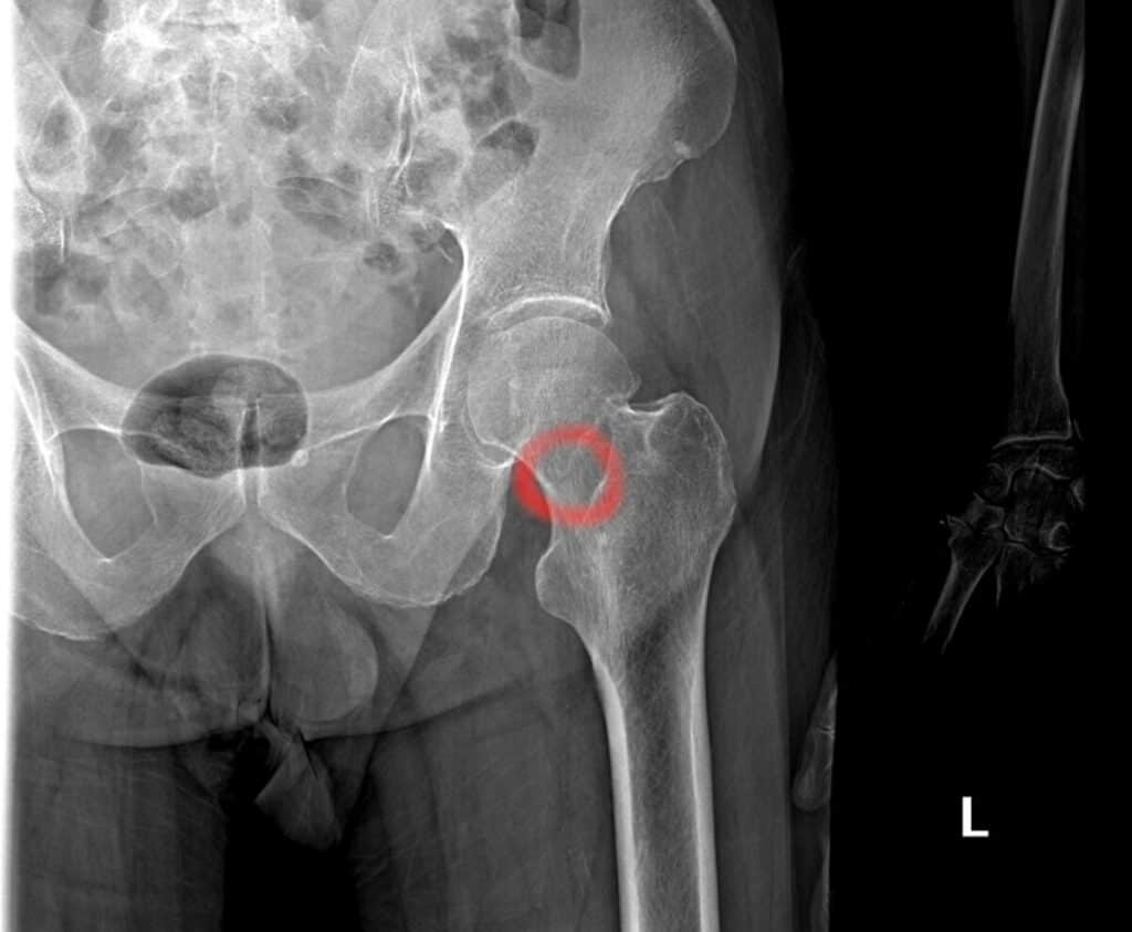 Hip Stress Fracture X-ray