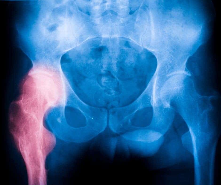 Hip Stress Fracture X-ray