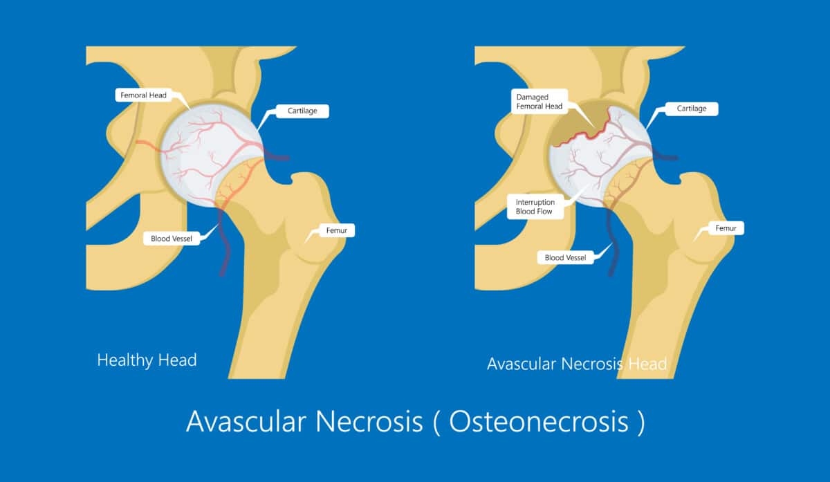 Perthes Disease Advice and Treatment from a Physical Therapist