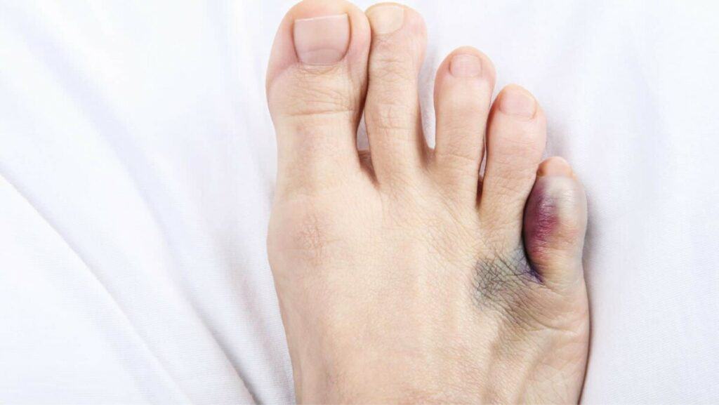 Picture of a bruised and Sprained Pinky Toe