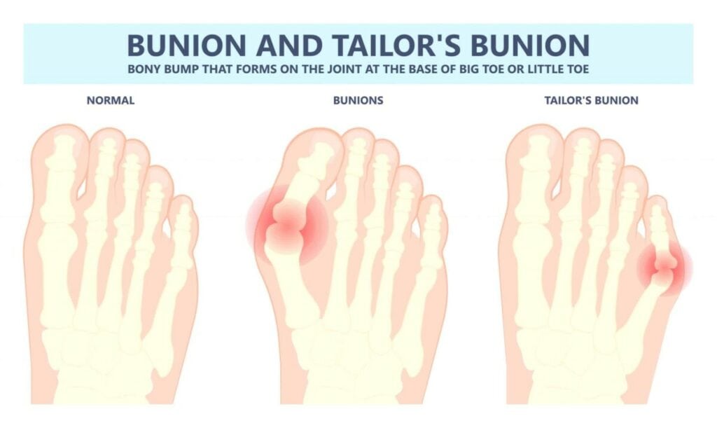 Tailors Bunion Diagram