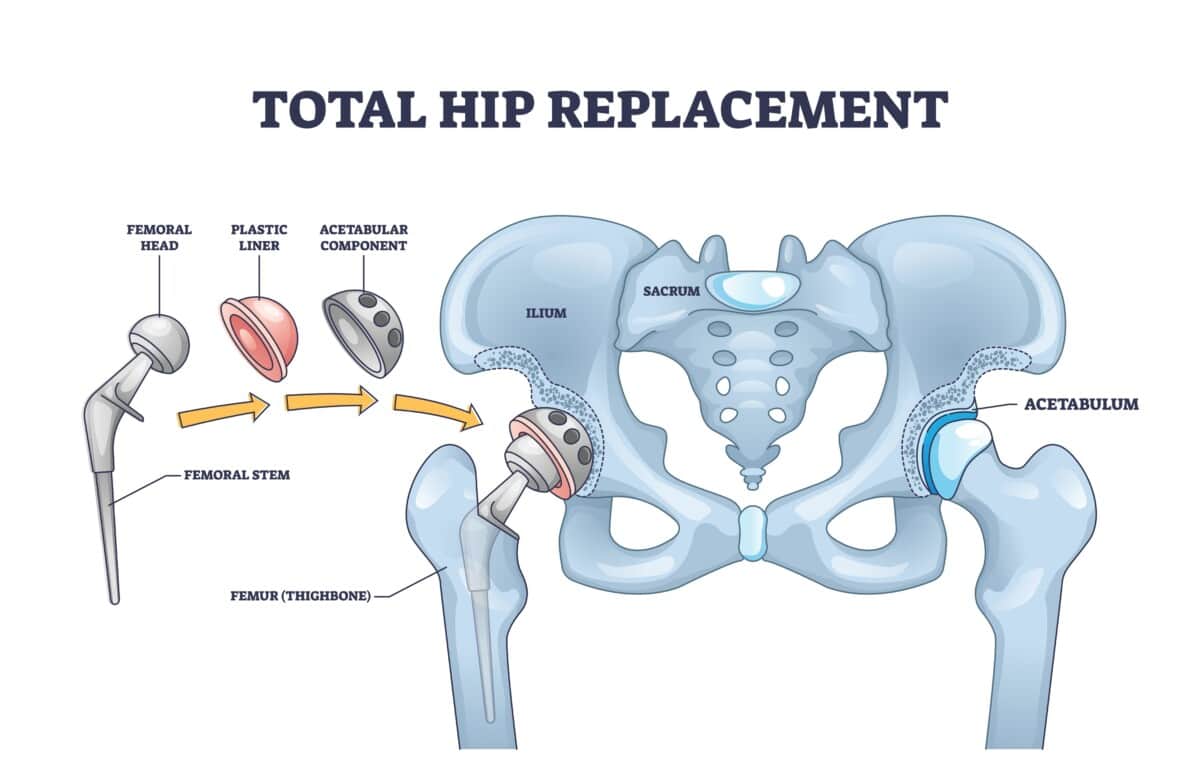 a) Components of a total hip replacement; (b) The components