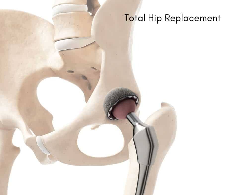 Total Hip Replacement Illustration
