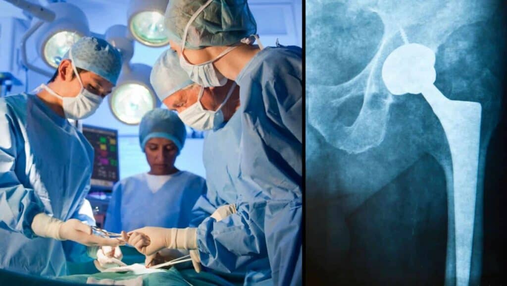 Picture of Total Hip Replacement Surgery