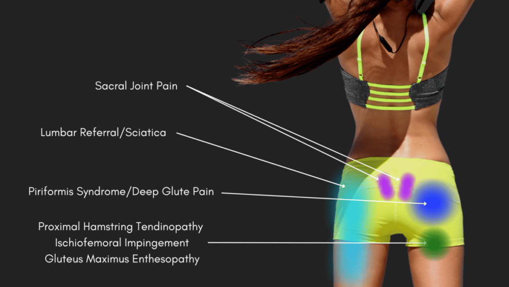 Back of hip pain location diagram