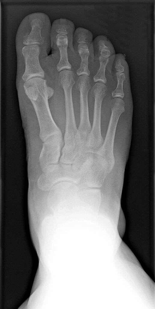 X-ray bone spur on 1st MTPJ