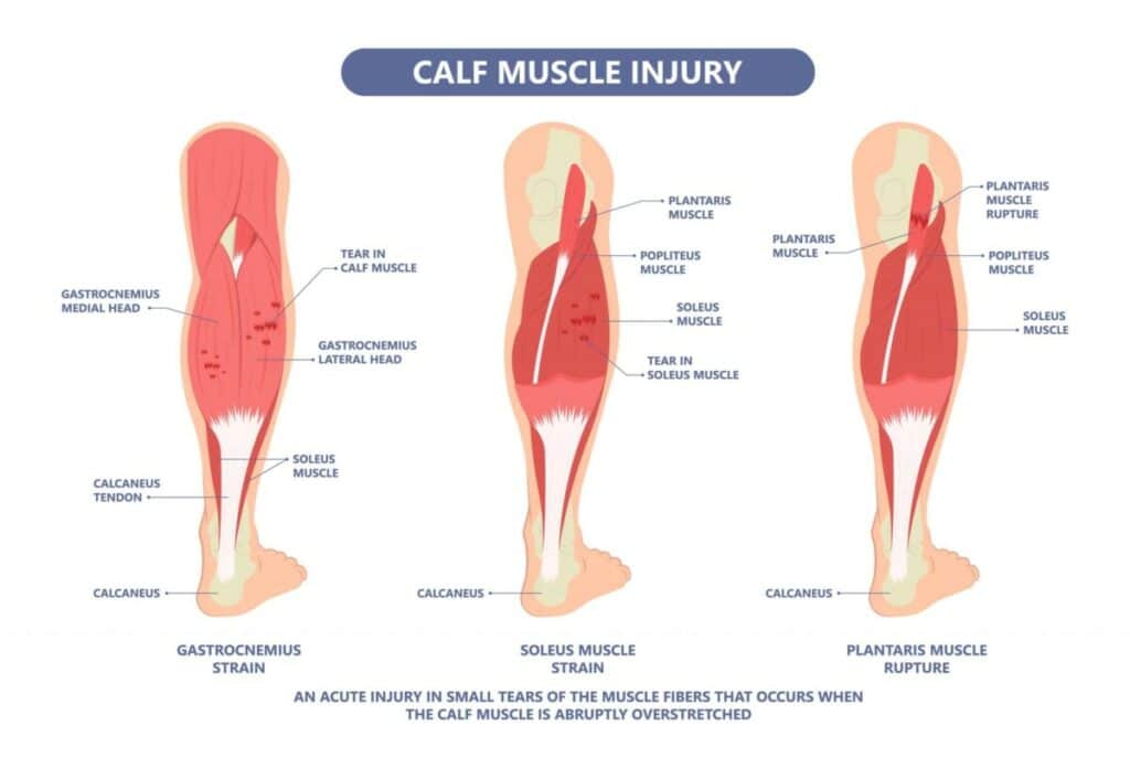 Calf Muscle Injury Diagram