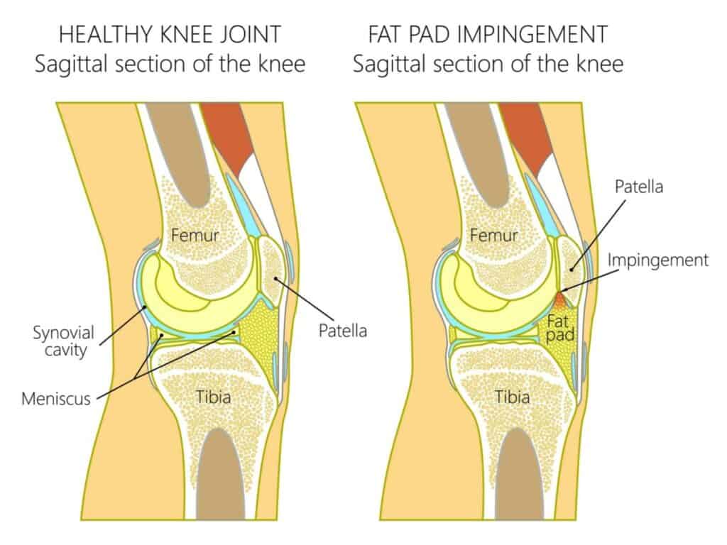 Knee Fat Pad Impingement diagram