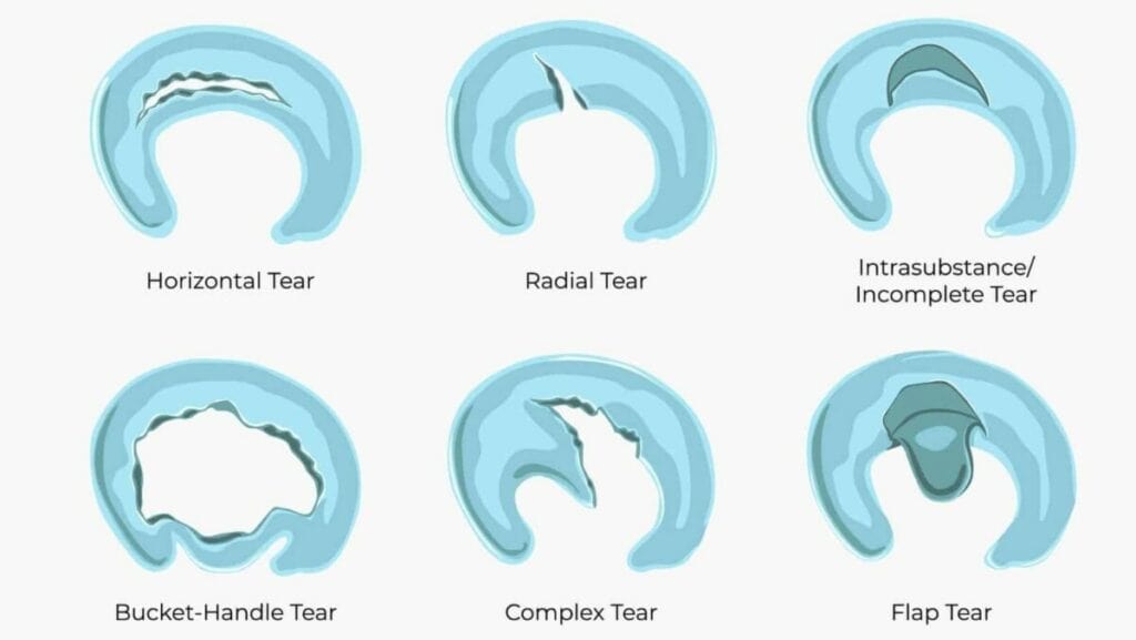 Meniscus tear types diagram