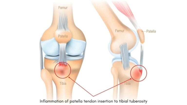 5-causes-of-sharp-stabbing-pain-in-the-knee-that-comes-goes