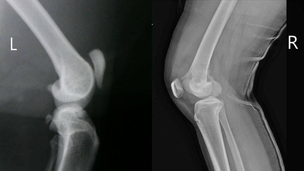 x-ray of Patella Alta