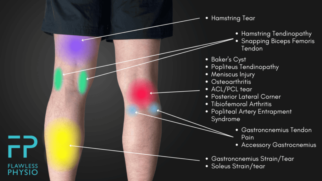 Back of Knee Pain Location Chart