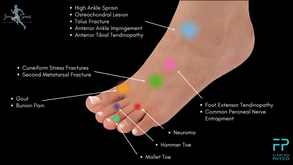 Top of Foot Pain Chart