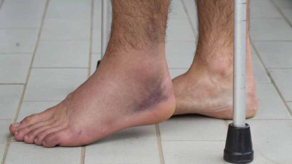 Picture of Bruised sprained ankle