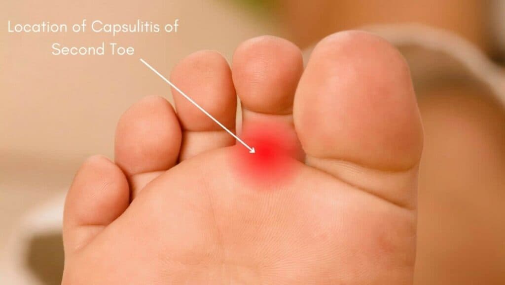 Picture of Location of capsulitis of second toe