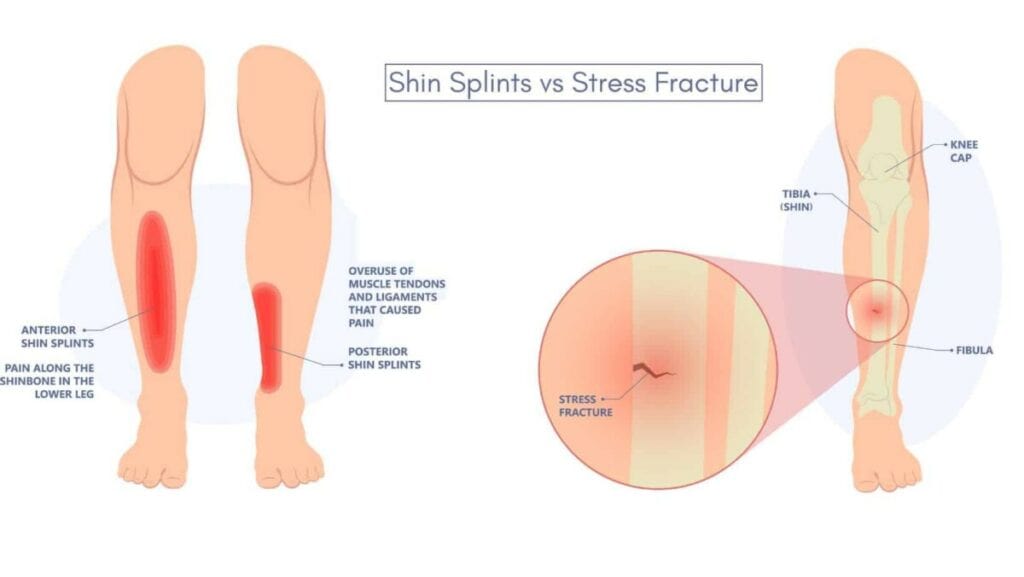 Diagram of Shin Splints vs Stress Fracture