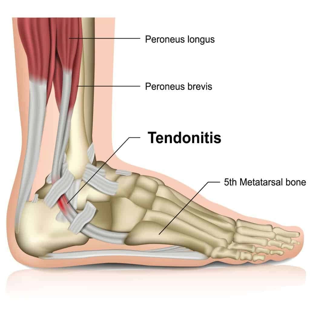 Peroneal Tendonitis Diagram