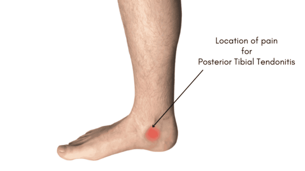 mage of a foot with an arrow pointing to the medial ankle, showing a red blur indicating the pain location associated with Posterior Tibial Tendonitis.