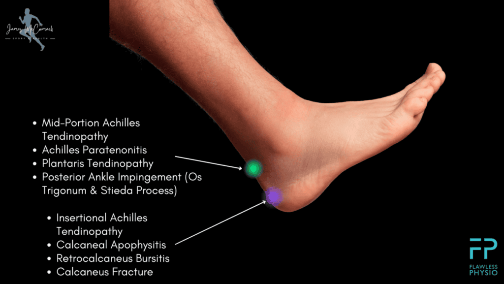 Diagram of a foot showing the locations of posterior ankle pain conditions with arrows, including conditions like Achilles Tendinopathy, Retrocalcaneal Bursitis, and Os Trigonum Syndrome.